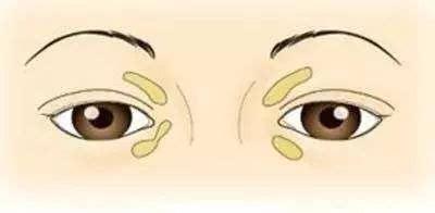 眼瞼病