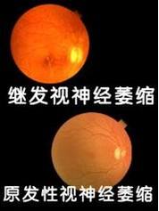 視神經萎縮