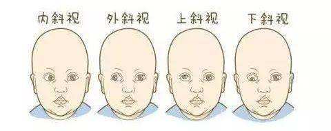共同性內斜視