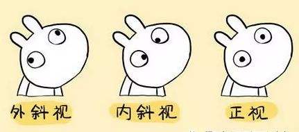 垂直斜視