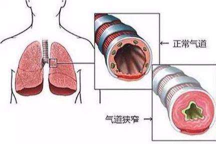氣管狹窄