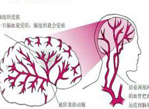 眼缺血綜合征
