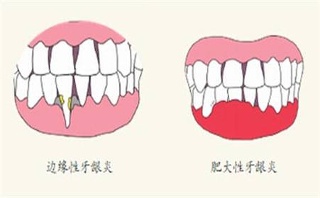 牙齦炎