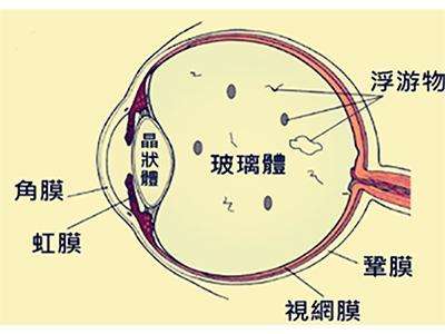 玻璃體后脫離