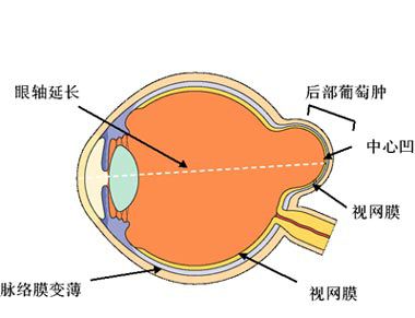 鞏膜葡萄腫