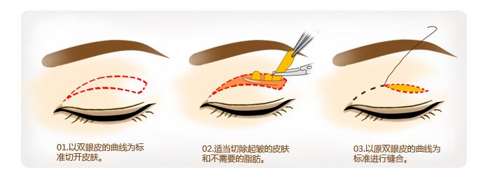 內眥贅皮