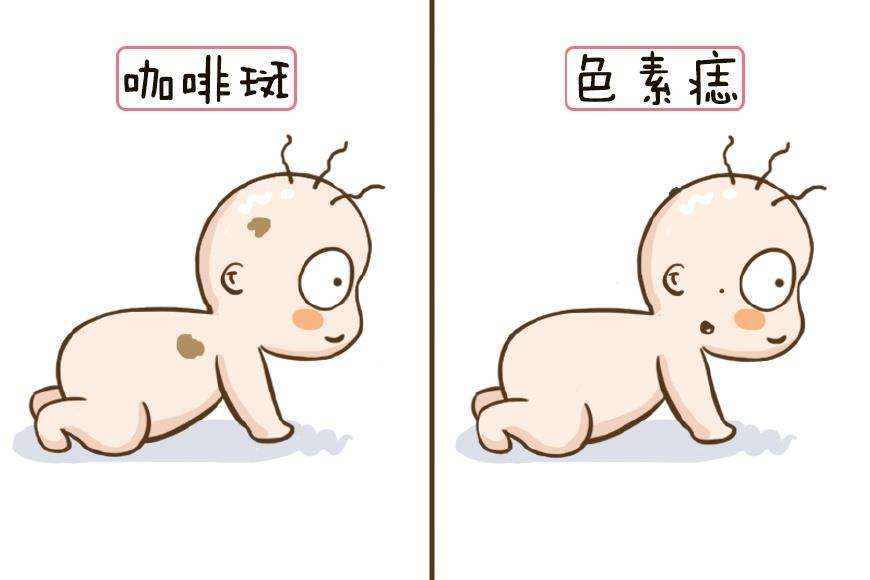 眼瞼色素痣