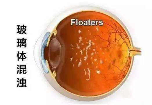 玻璃體混濁