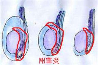 附睪炎
