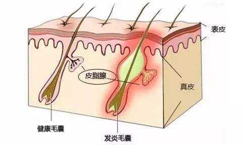 毛囊炎