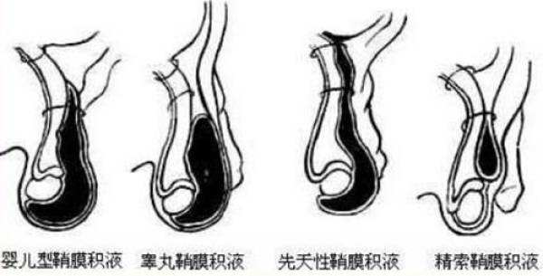 睪丸鞘膜積液