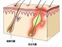 癰