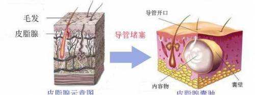 皮脂腺囊腫