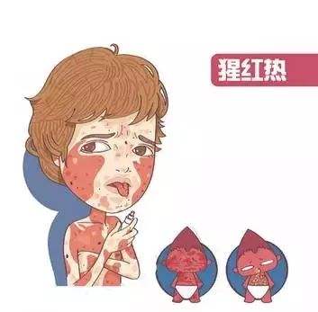 猩紅熱