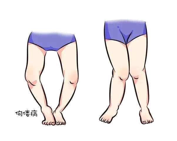 新生兒佝僂病