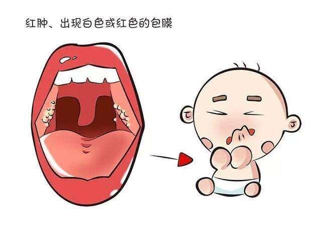 嬰幼兒化膿性淋巴結炎