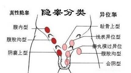 小兒隱睪癥