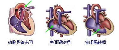 小兒室間隔缺損