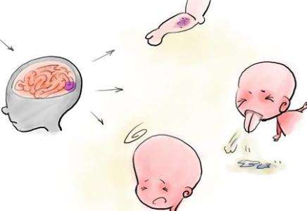 小兒腦炎