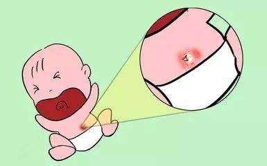 新生兒臍炎