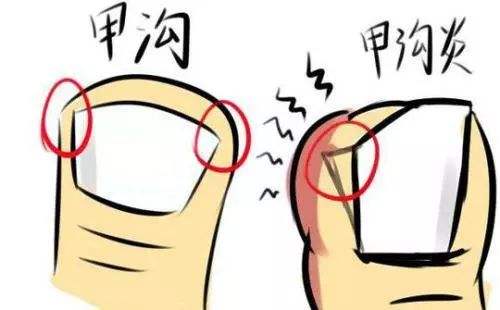 甲溝炎