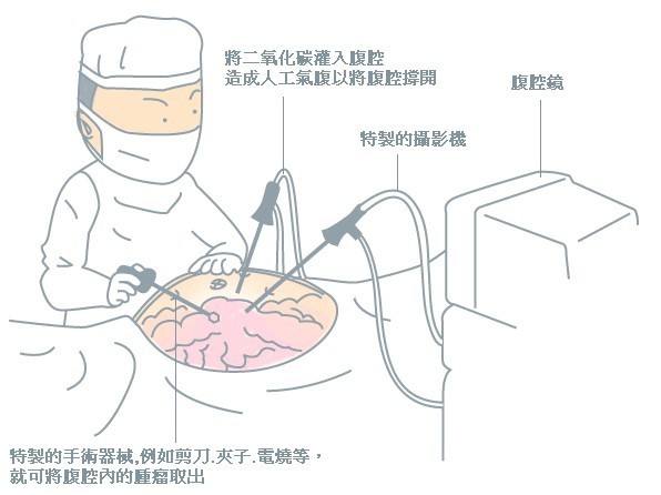 腹腔鏡手術