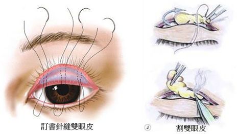 雙眼皮手術(shù)