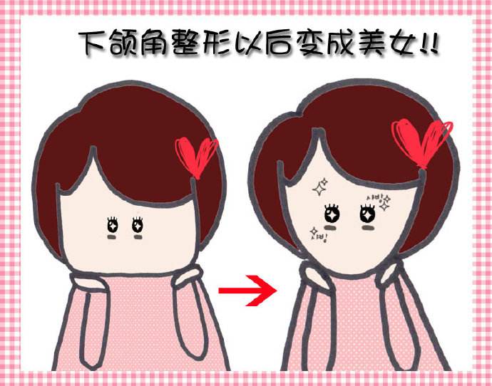 下頜整形