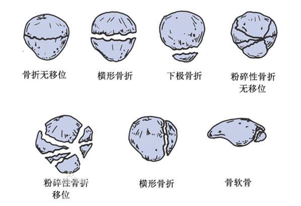 髕骨骨折