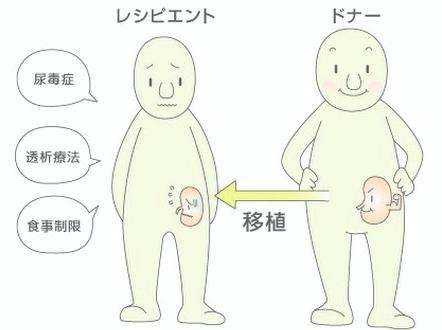 腎移植