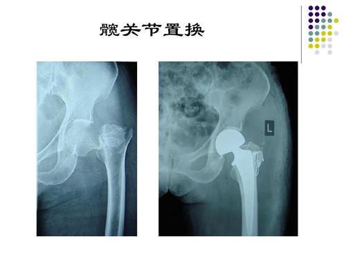 髖關(guān)節(jié)置換術(shù)