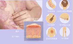 牛皮癬