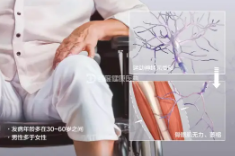 肌萎縮側索硬化
